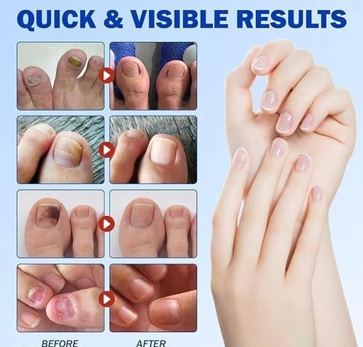 Overnight Nail Repair Patches – Easy Hydrogel Nail Care